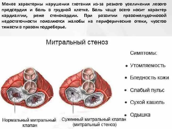 Пороки сердца стеноз митрального клапана. Приобретенные пороки сердца митральный стеноз. Стеноз и недостаточность митрального клапана. Пороки митрального клапана стеноз. Митральный стеноз признаки