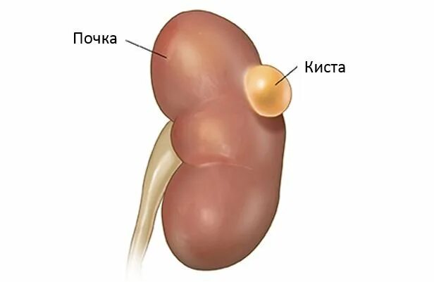 Как выглядит киста внутри А она может лопнуть или разорваться Киста яичника полный гид по патологии О з