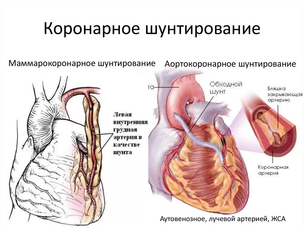 Шунт в медицине. Схема операции аортокоронарного шунтирования. Аорто маммарокоронарное шунтирование. Коронарное шунтирование схема. Аортокоронарное шунтирование этапы операции.