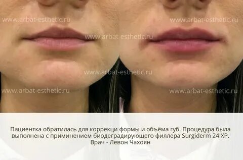 Увеличение губ гиалуроновой кислотой отзывы