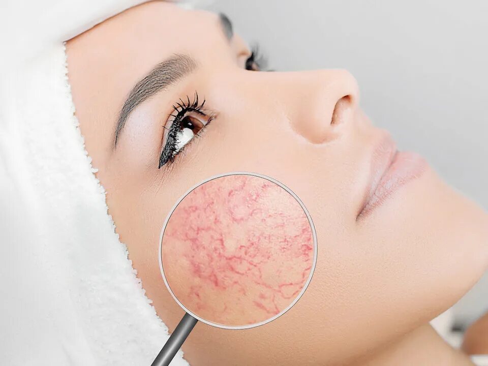 Омоложение сосудов