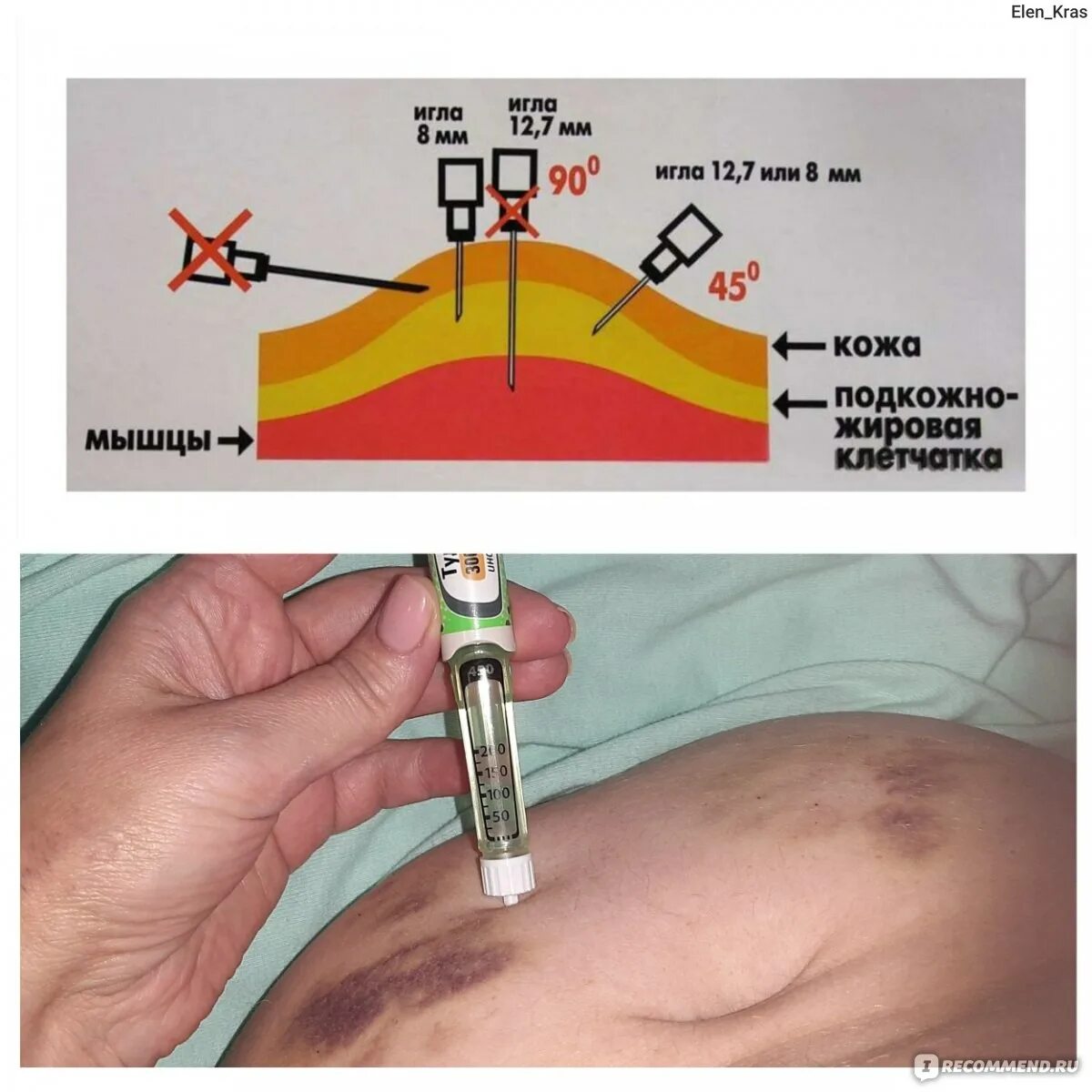 Когда колят инсулин. Игла для инсулина подкожно. Иглы для инсулиновых инъекций. Укол инсулина. Иглы для введения инсулина размер.