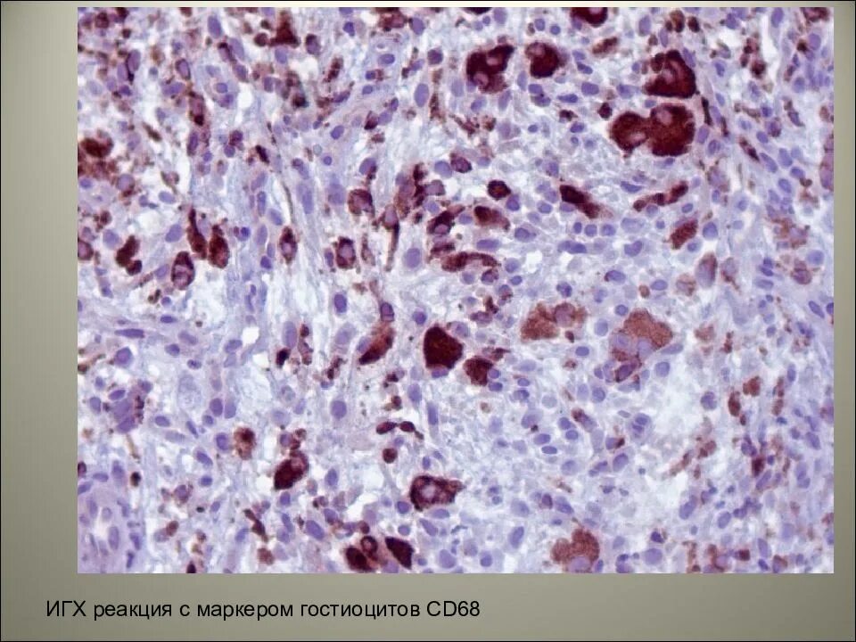 Иммуногистохимические маркеры. Криволапов ИГХ лимфома. Иммуногистохимия костной ткани. ИГХ. ИГХ маркеры.
