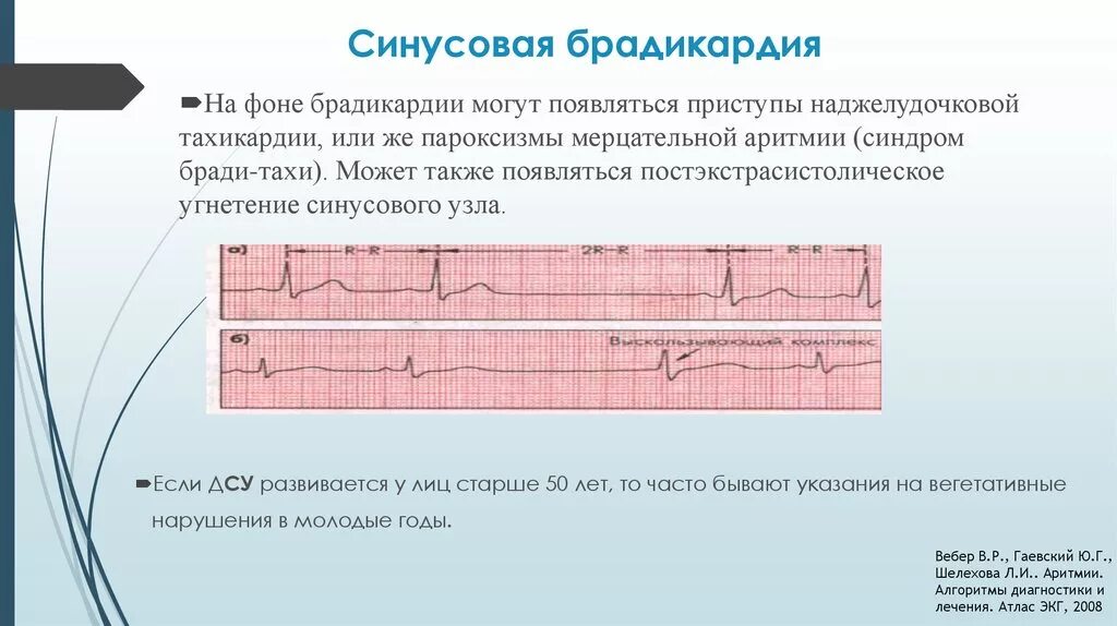 Дисфункция синусового узла что это. Синусовая брадикардия на ЭКГ 25 мм. Брадикардия синусового узла. Синдром тахикардии-брадикардии на ЭКГ. Пароксизмальная брадикардия ЭКГ.