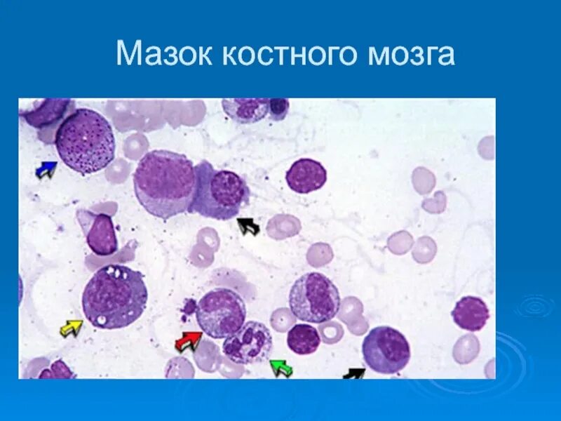 Красный костный мозг мазок. Ретикулярные клетки красного костного мозга. Красный костный мозг мазок гистология. Срез красного костного мозга гистология. Мазок костного мозга гистология.