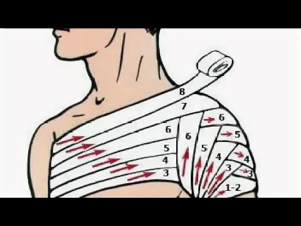Плечевая повязка алгоритм. Техника наложения колосовидной повязки на плечо. Колосовидная повязка на плечевой сустав алгоритм. Техника наложения колосовидной повязки на плечевой сустав. Колосовидная бинтовая повязка.