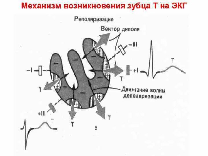 Расщепление зубца