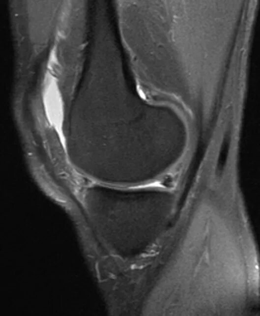 Разрыв мениска мрт. Повреждение медиального мениска коленного сустава мрт. Рампа медиального мениска. Повреждение мениска коленного сустава мрт классификация.
