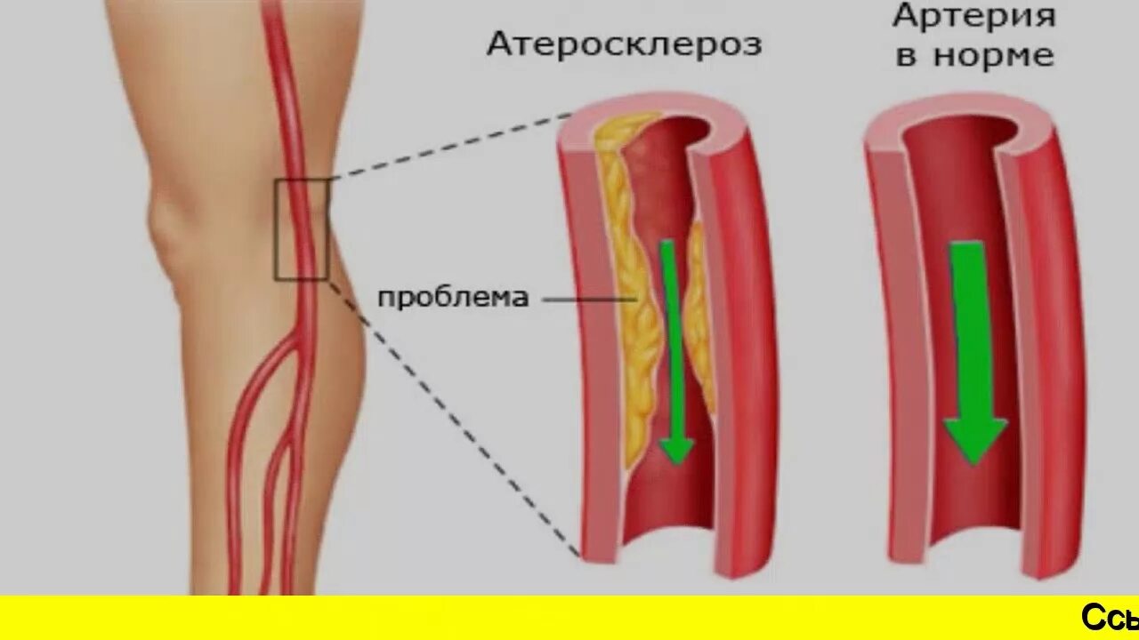 Атеросклеротические изменения сосудов. Атеросклероз нижних конечностей. Бляшки при атеросклерозе.