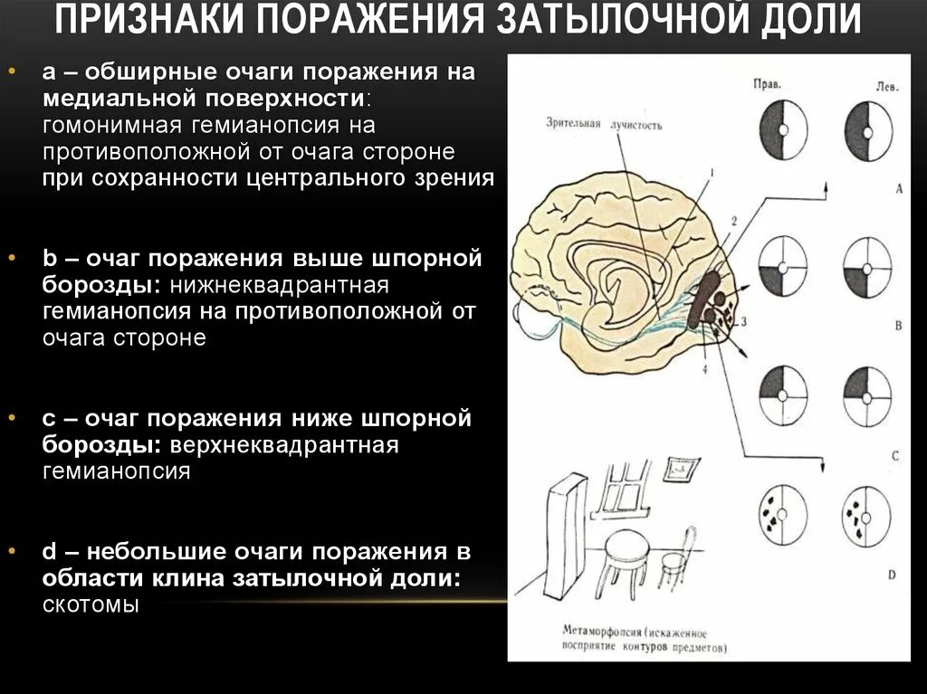 Затылочная область коры головного мозга. Поражение затылочной доли головного мозга симптомы. Симптомы поражения затылочной доли неврология. Повреждение затылочной доли головного мозга. Синдромы поражения отдельных лобных долей.