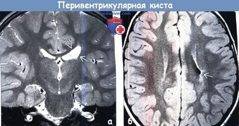 Киста 19 мм