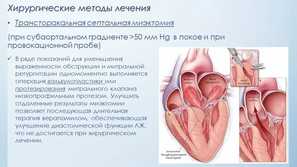 Операции при гипертрофической кардиомиопатии. Чрезаортальная септальная миоэктомия.. Миоэктомия