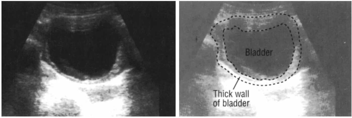 Как быстро наполнить мочевой пузырь. Стенки мочевого пузыря утолщены УЗИ. Утолщение стенки мочевого УЗИ. Расслоение стенки мочевого пузыря УЗИ. Утолщение стенки мочевого пузыря на УЗИ.