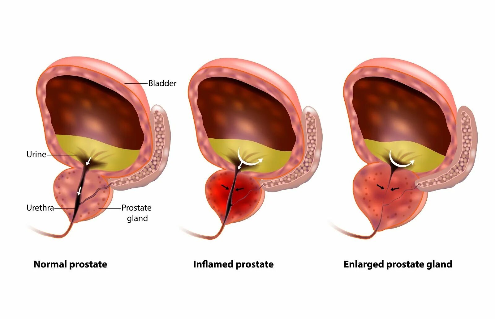 Сколько длится простата. Шаровидная предстательная железа. Увеличение объема предстательной железы. 107. Аденома предстательной железы.. Предстательная железа форма шаровидная.