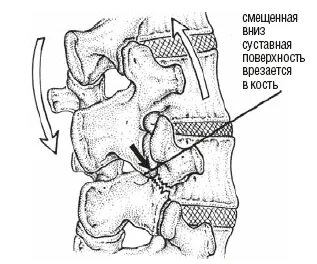 Дугоотростчатые суставы позвонков