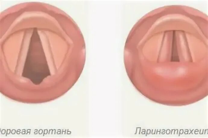 Код фаринготрахеита