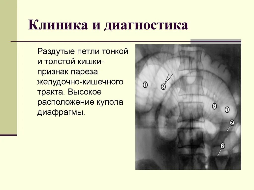 Вздутые петли кишечника. Раздутые петли тонкого кишечника. Расширение петель кишечника