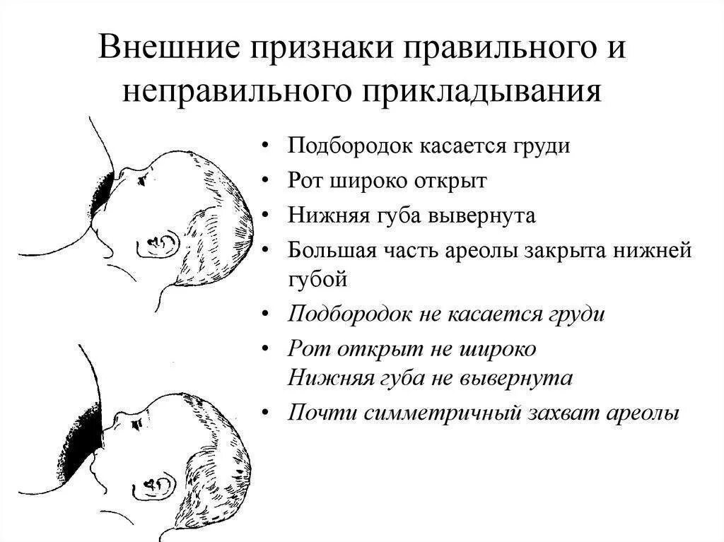 Трещины при вскармливании