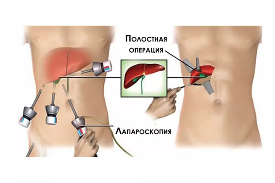 Удалили желчный пузырь как жить. Лапароскопия желчного шрамы. Холецистэктомия желчного пузыря лапароскопическая. Холецистит и лапароскопическая холецистэктомия. ЖКБ лапароскопическая холецистэктомия.