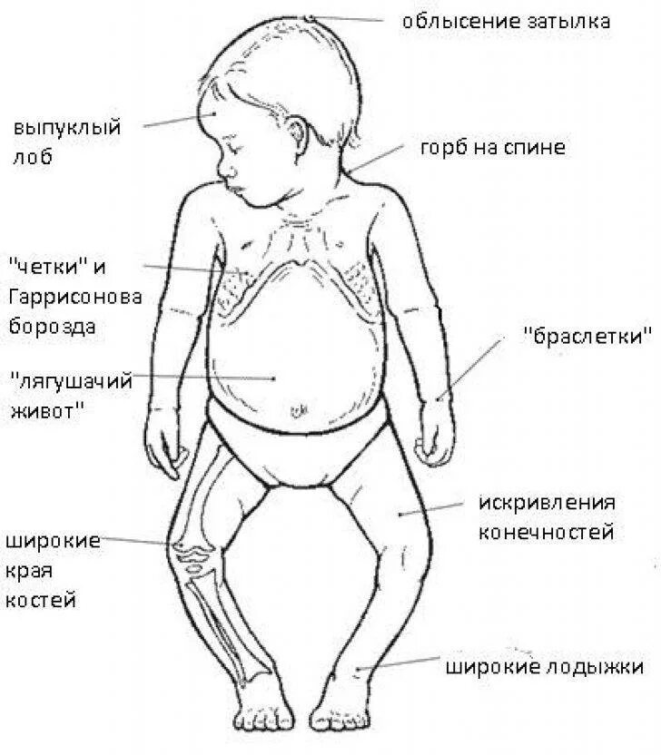 Разит купить. Симптомы рахита Гаррисонова борозда. Симптомы рахита у грудничка в 6 месяцев. Рахит (дефицит витамина d). Рахит у 7 месячного ребенка.