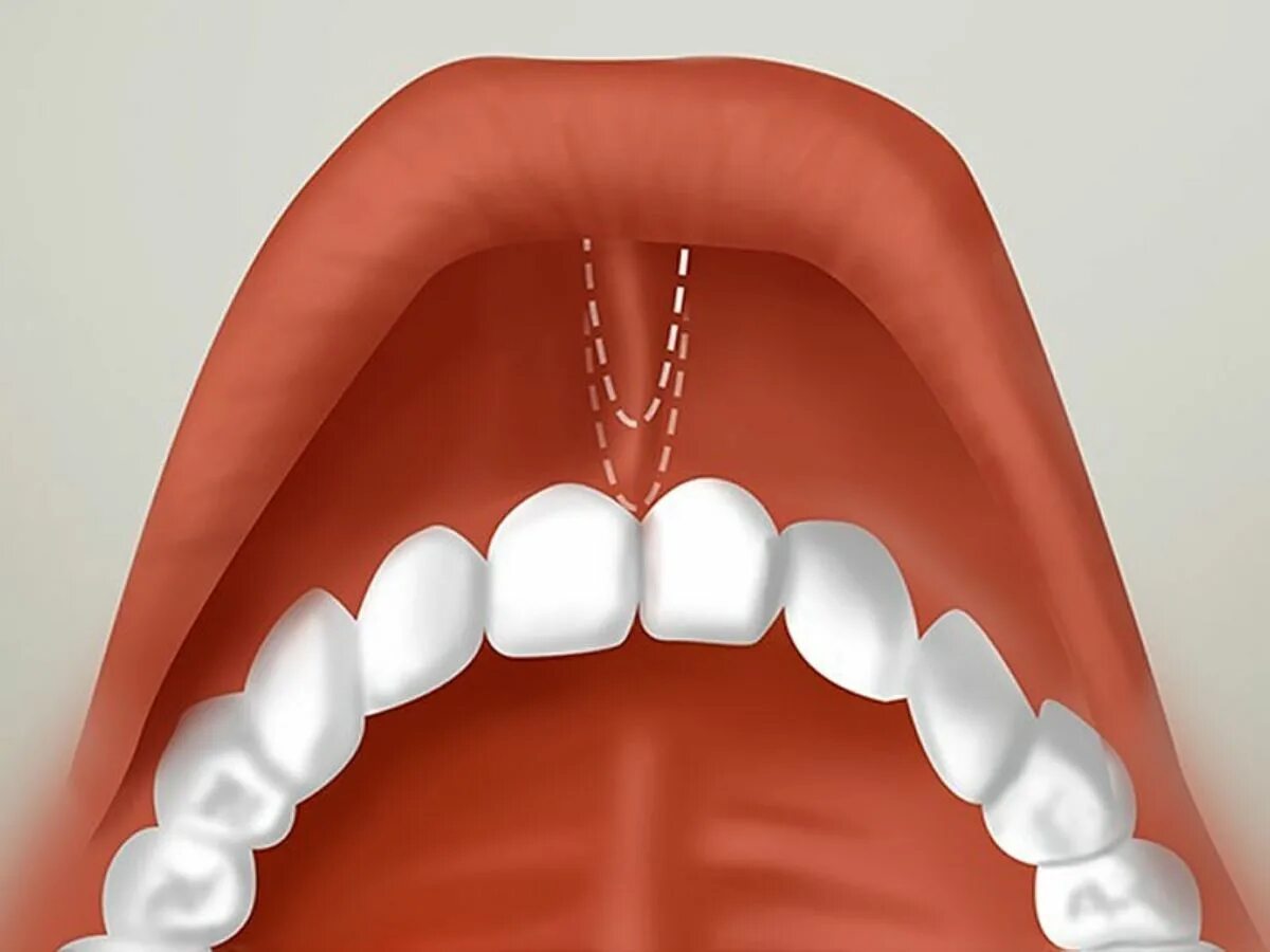 зубы стоматология. френулопластика (пластика уздечки). губ на удаленный зуб. ботулинотерапия десневая улыбка. Xr brands расширитель рта cheek retractor dental mouth gag.