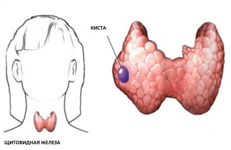 Токсическая аденома щитовидной железы. Кистозный зоб щитовидной железы. Микрокиста щитовидной железы. Зоб тест