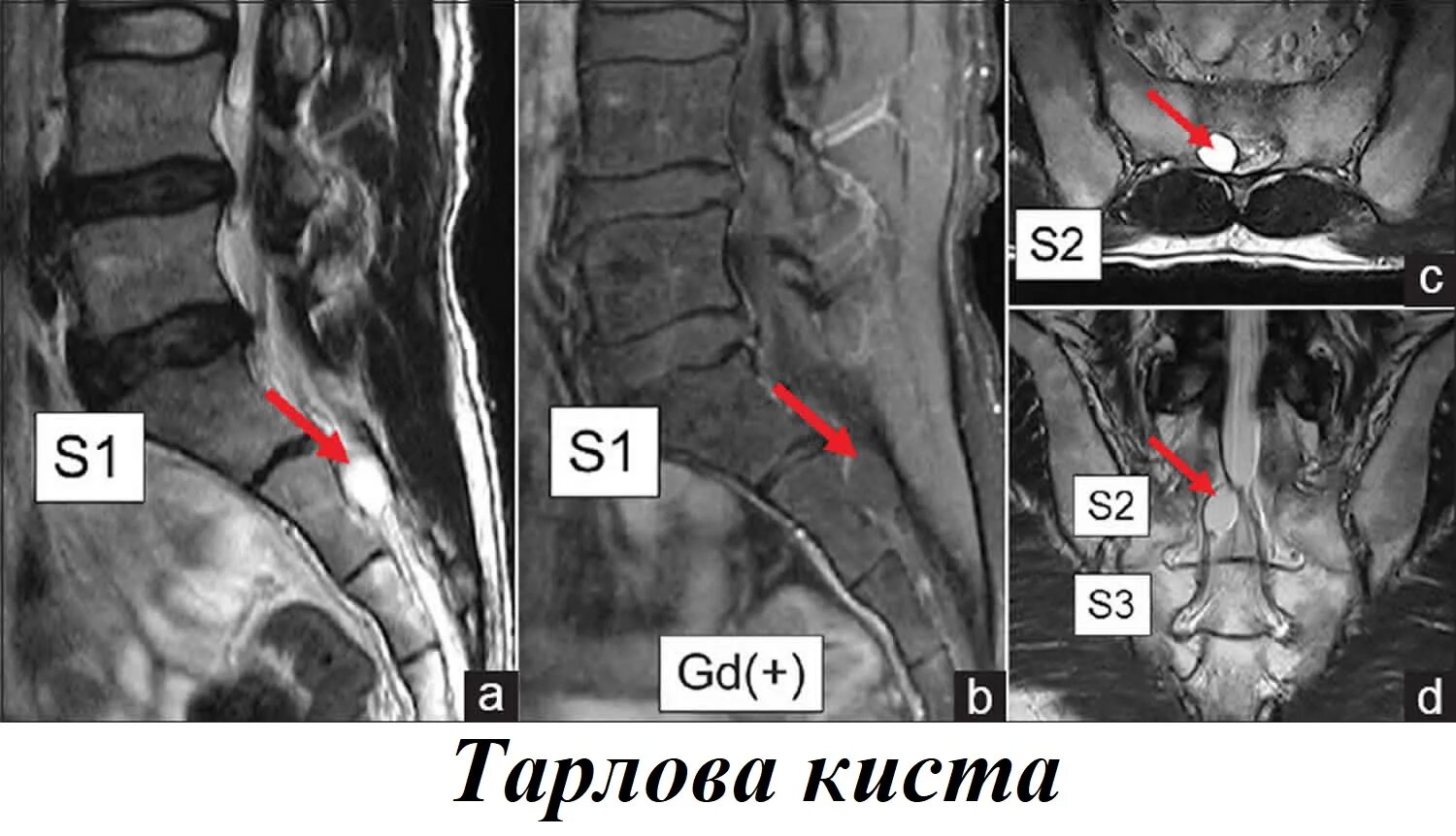 Периневральная киста l5-s1. Периневральная киста позвоночника поясничного отдела s1. Киста в пояснице