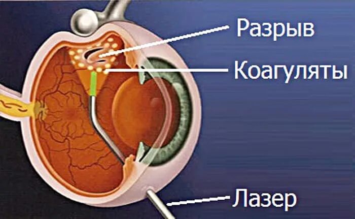 Сетчатка отслоение лечение лазером. Сетчатка отслоение лечение лазером