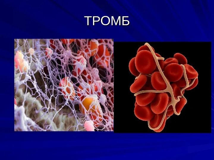 Описание тромба. Структура тромба. Строение красного тромба.