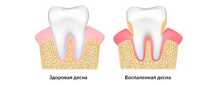 Воспаление десен полоскать. Болит Десна полоскание. Воспалилась Десна полоскание. Можно полоскать десна содой