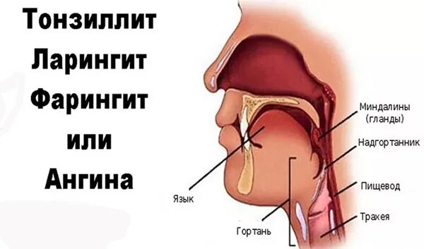 Файл:Laryngitis.png - Википедия