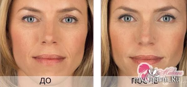 Уколы гиалуроновой кислоты до и после. Гиалуронка инъекции для лица. Препараты для биоревитализации лица. Где сделать уколы гиалуроновой кислоты. Гиалуроновая кислота уколы.
