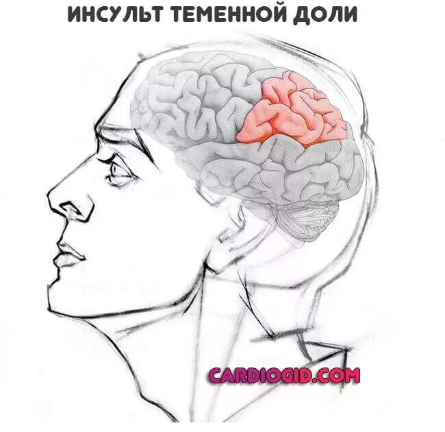 Инсульт в теменной доле. Боль в височно теменной области. Инсульт правой теменной доли.