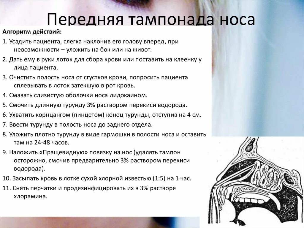 Тампонада носа при носовом кровотечении. Передняя и задняя тампонада при носовом кровотечении алгоритм. Задняя тампонада полости носа алгоритм. Передняя тампонада полости носа алгоритм. Передняятомпонада носа.