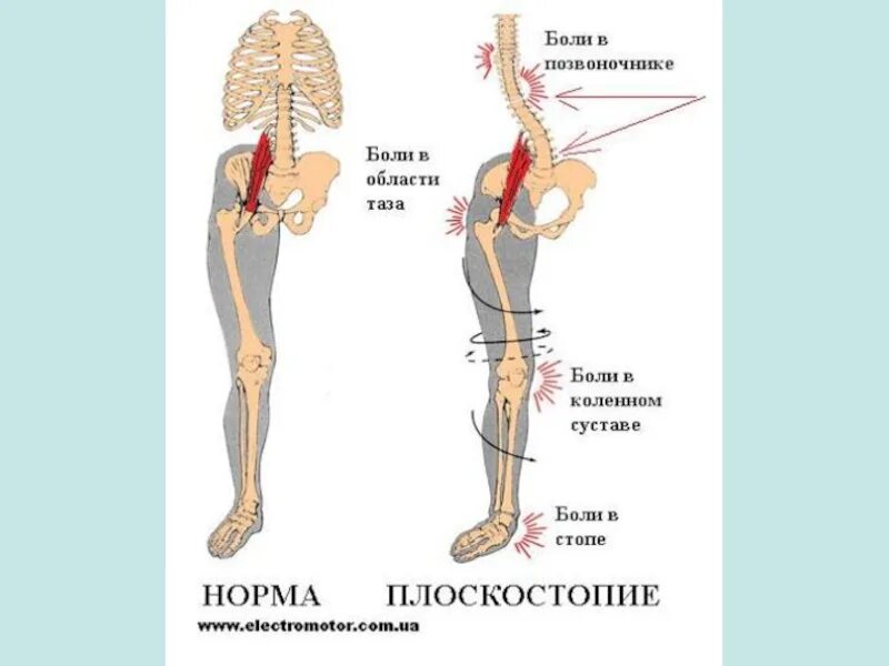 Почему боль отдает в ногу. Стопы и позвоночник взаимосвязь. Болит нога в области таза.