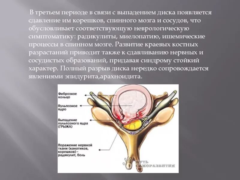 Сдавление спинного. Компрессия Корешков спинного мозга. Выпадение спинного мозга. Сдавление спинного мозга доклад. Сдавление спинного мозга и его Корешков.