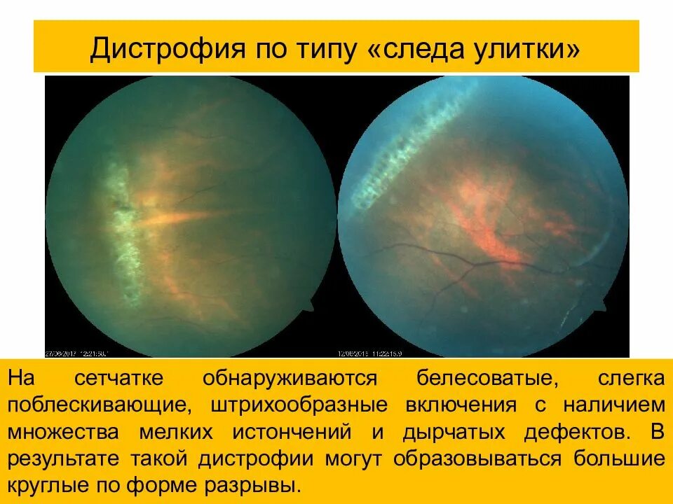 Пвхрд решетчатая дистрофия. Периферическая витреохориоретинальная дистрофия сетчатки. Периферическая лазеркоагуляция сетчатки глаза. Периферическая витреохориоретинальная дегенерация сетчатки. Ретикулярная дистрофия сетчатки.