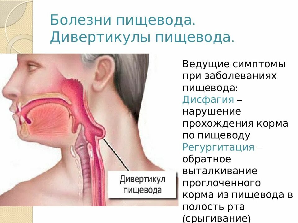 Основные заболевания пищевода. Симптомы поражения пищевода. Симптомы при заболеваниях пищевода. Пищевод болезни и симптомы.