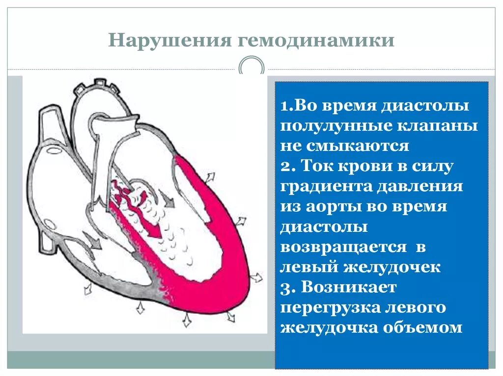 Приобретенные пороки сердца схема гемодинамики. Нарушения гемодинамики при приобретенных пороках сердца. Гемодинамика при приобретенных пороках сердца. Гемодинамика при аортальной недостаточности схема. Митральная недостаточность гемодинамика