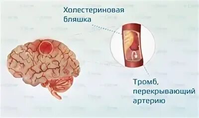 Инфаркт мозга неуточненный. Ишемический инсульт атеротромботический клиника. Атеротромботический инсульт головного мозга. ЦВБ инфаркт головного мозга ,атеротромботический. Атеротромботический инсульт картинки.