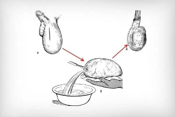 Операция Винкельмана Бергмана. Операции Винкельмана Бергмана при гидроцеле. Водянке яичка (Винкельмана, Бергмана-Израэля).. Операция Винкельмана и Бергмана при водянке яичка. Компресс яичка