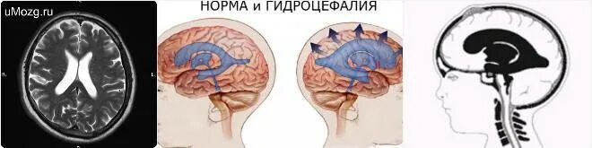 Обструктивная гидроцефалия. Острая обструктивная гидроцефалия. Смешанная заместительная гидроцефалия. Шунт головной мозг ликвора.