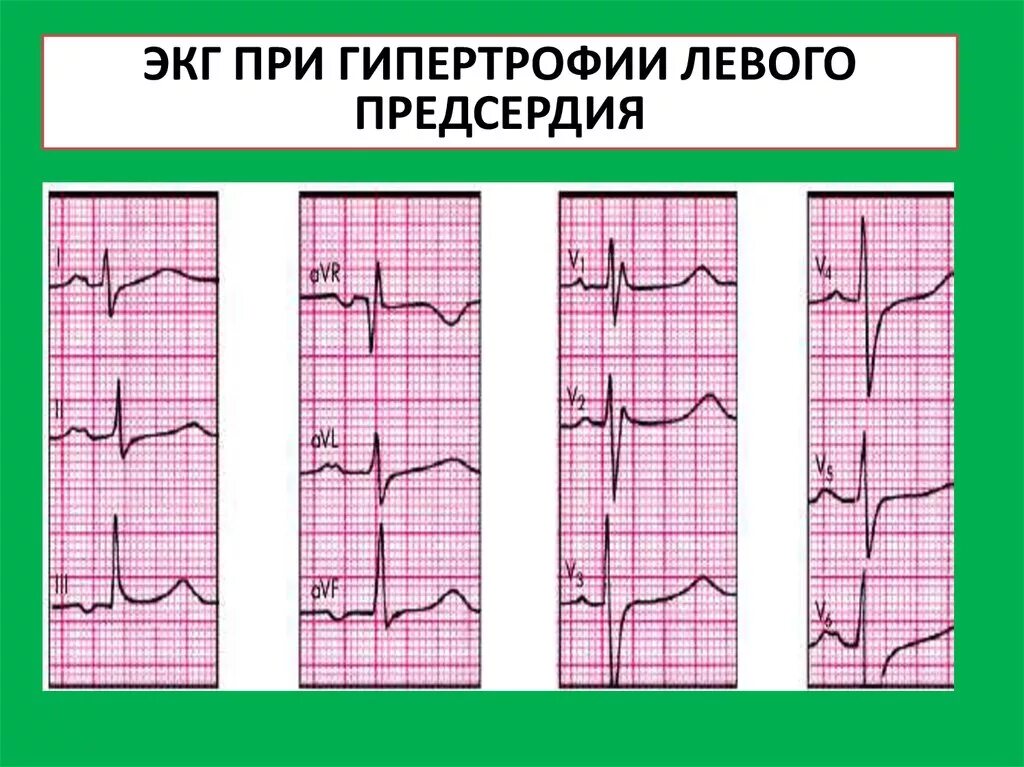 Гипертрофия правых отделов на ЭКГ. Гипертрофия левого предсердия на ЭКГ. ЭКГ - синдром гипертрофии предсердий.. Гипертрофия левого предсердия и правого желудочка на ЭКГ. Гипертрофия левого предсердия левого желудочка