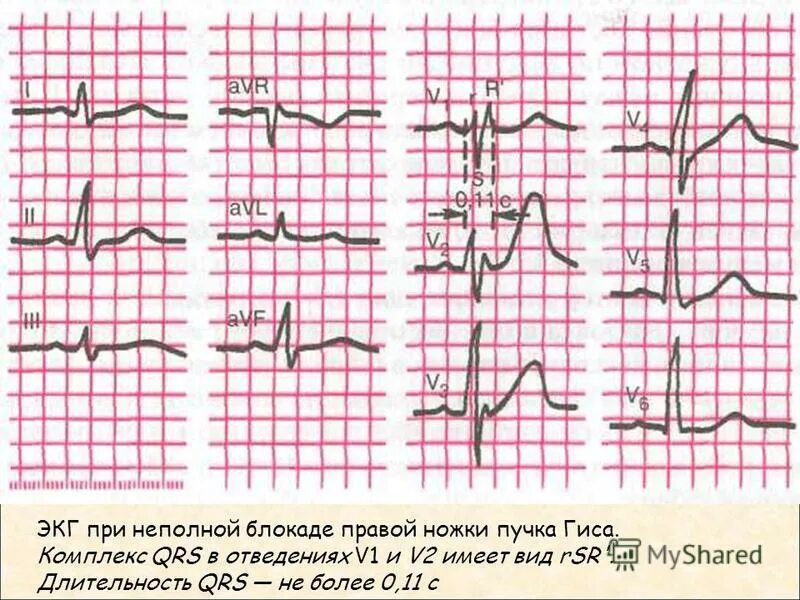 Разветвление верхней левой ножки пучка гиса. Кардиограмма сердца блокада правой ножки пучка Гиса. Правая неполная блокада правой ножки пучка Гиса. ЭКГ признаки неполной блокады правой ножки. Неполная блокада правой ножки пучка Гиса критерии ЭКГ.