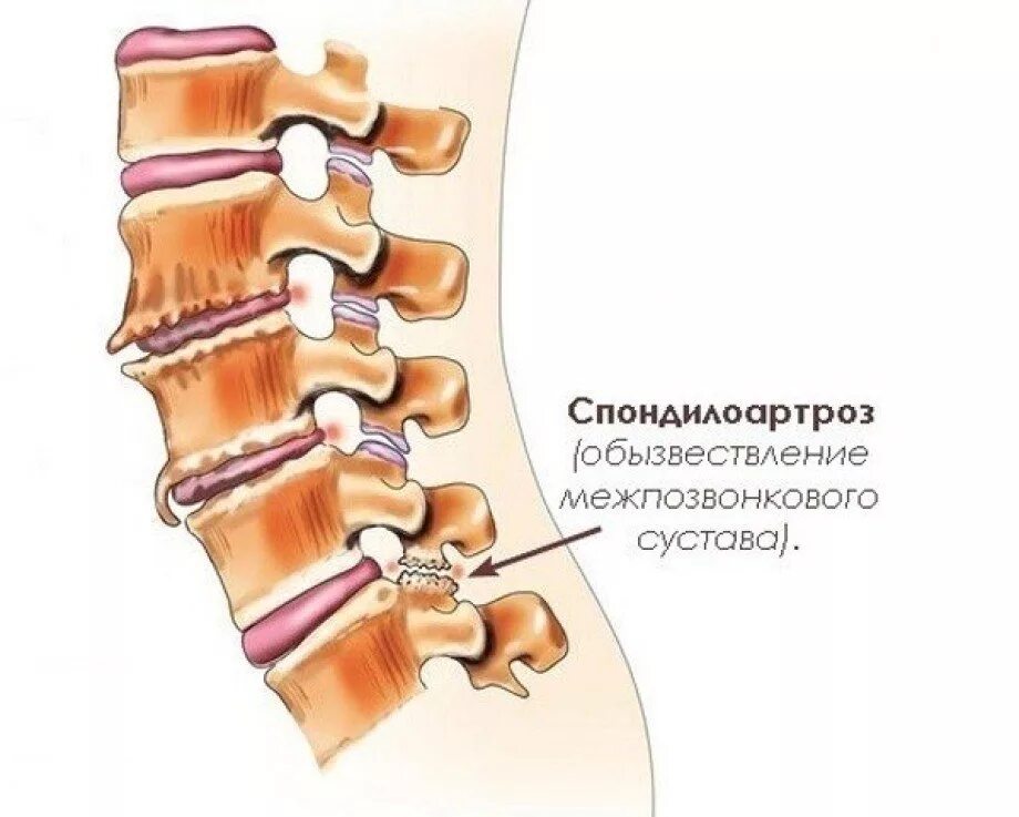 Спондилоартроз пояснично-крестцового отдела позвоночника. Остеофиты позвоночника l1-s1. Пояснично крестцовый спондилоартроз l1-s1. L4-s1 отдел позвоночника спондилоартроз. Остеохондроз с7