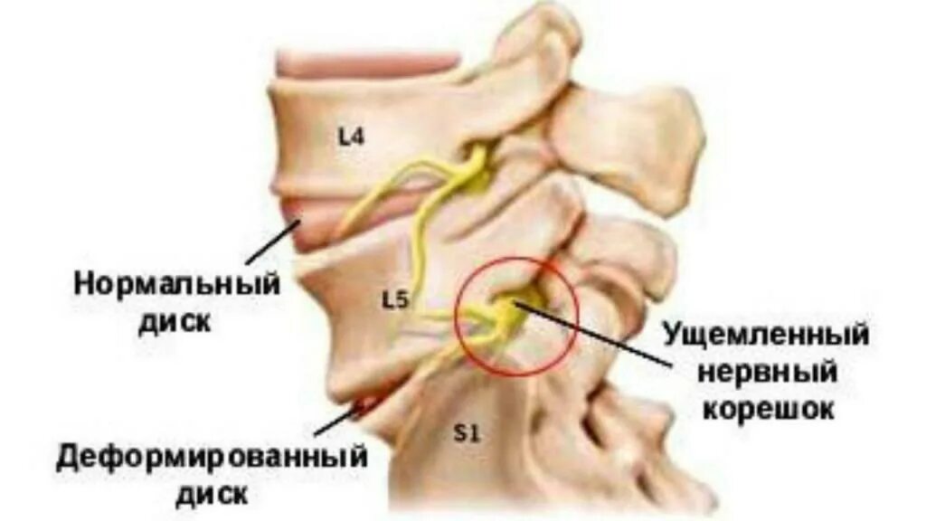 Корешковый синдром шейного отдела с4. Грыжа корешковый синдром. Защемление корешка пояснично-крестцового отдела позвоночника.