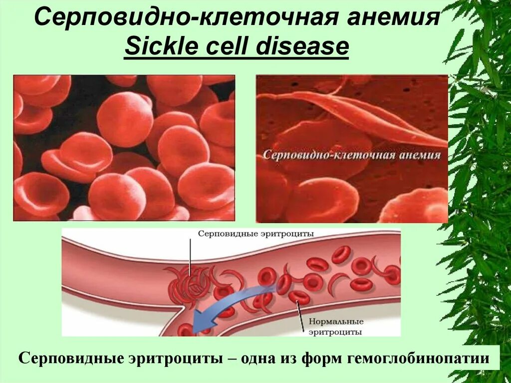 Серповидноклеточная анемия формы. Серповидноклеточная анемия (гемоглобинопатия). Серповидная анемия генное заболевание. Серповидноклеточная анемия Валин. Серповидно клеточная анемия эритроциты.
