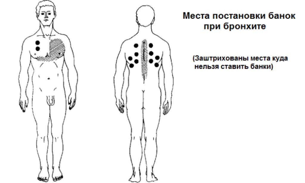 Схема постановки банок при бронхите. Схема баночного массажа при кашле. Схема установки вакуумных банок. Схема постановки банок при пневмонии.