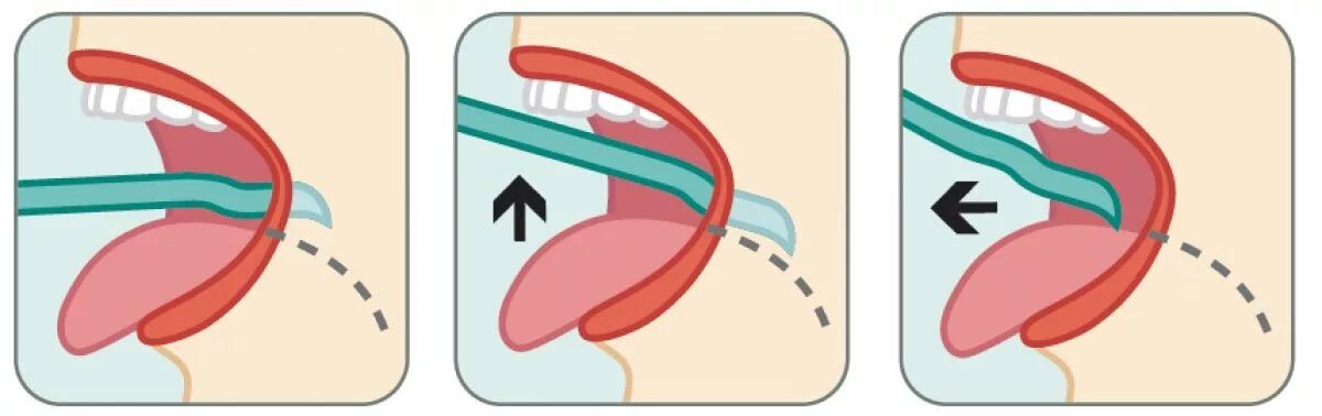 Рвотный рефлекс при чистке. Чистка языка от налета скребком. Чистка языка зубной щеткой. Как правильно чистить язык.