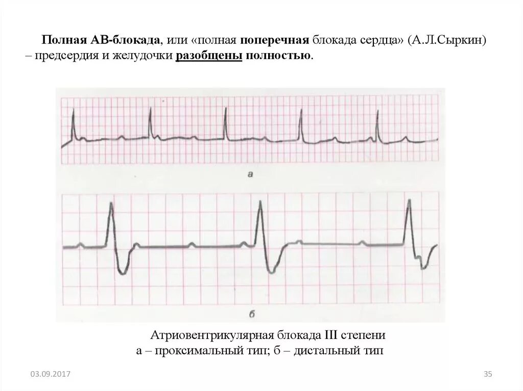 Fuller av. АВ блокада 3 степени дистальный Тип. Полная поперечная атриовентрикулярная блокада сердца на ЭКГ. АВ блокада 3 степени проксимальный Тип. Поперечная блокада 3 степени на ЭКГ.